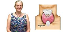 Thyroid Case Study - Robyn Nelson