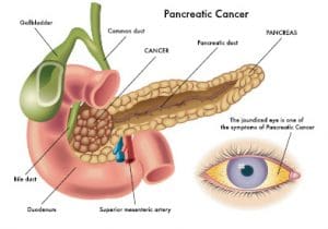 pancreatic-cancer