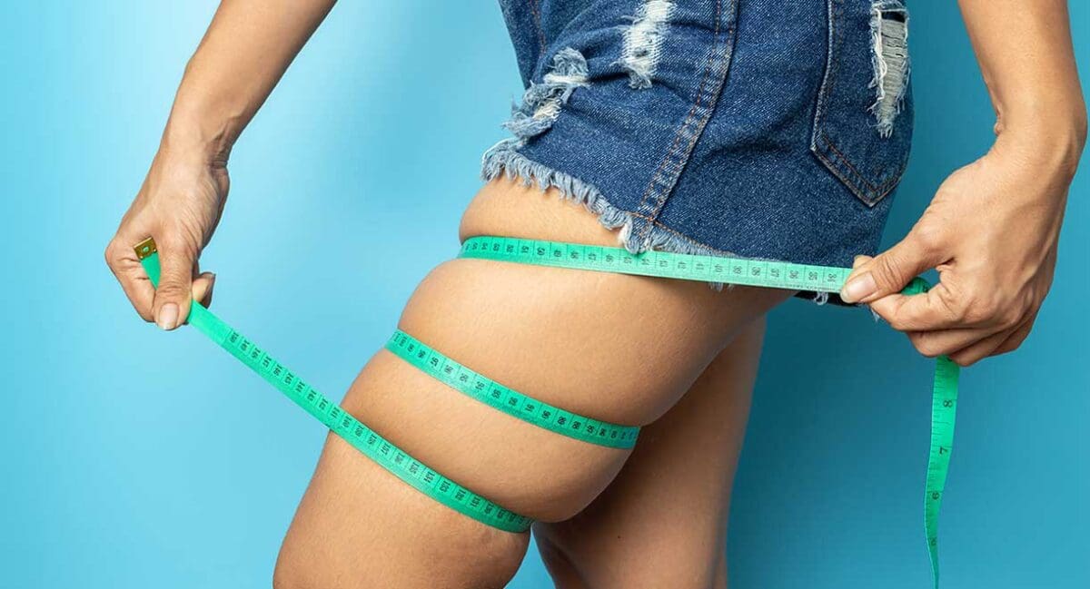 Do You Have A Lot Of Excess Fat Or Fluid In Your Legs? (Lipidema) Dr