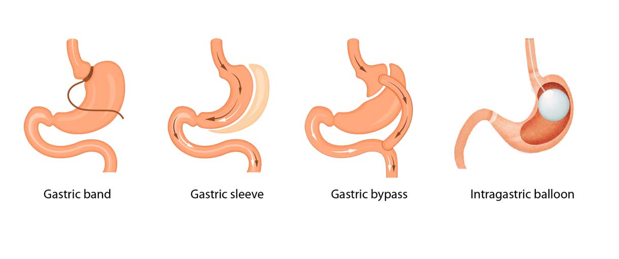 Sandra-Cabot-Gastric-Surgery