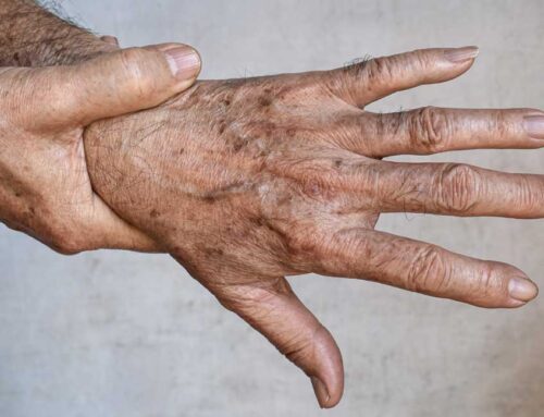 Brown Aging Spots