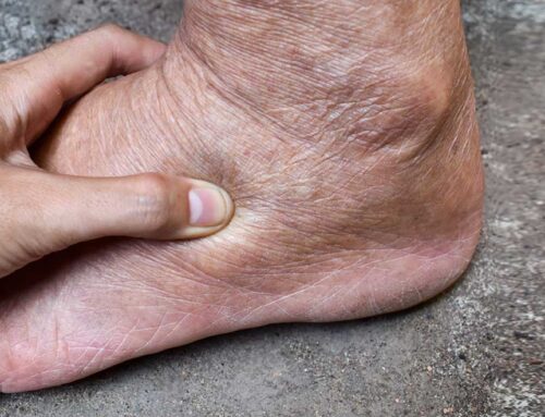 Fluid Retention